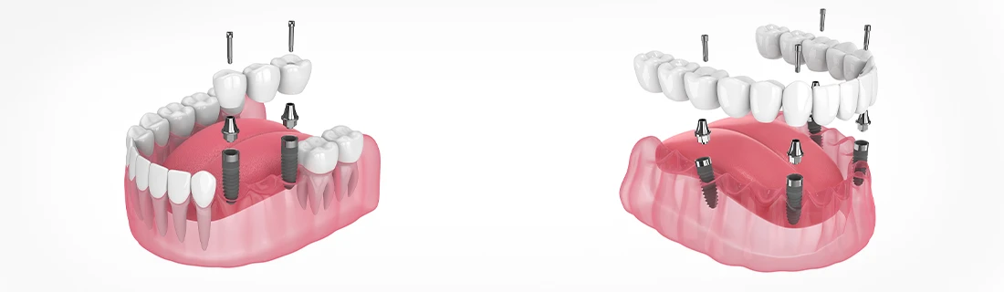 New Teeth in Flowood MS In One Day