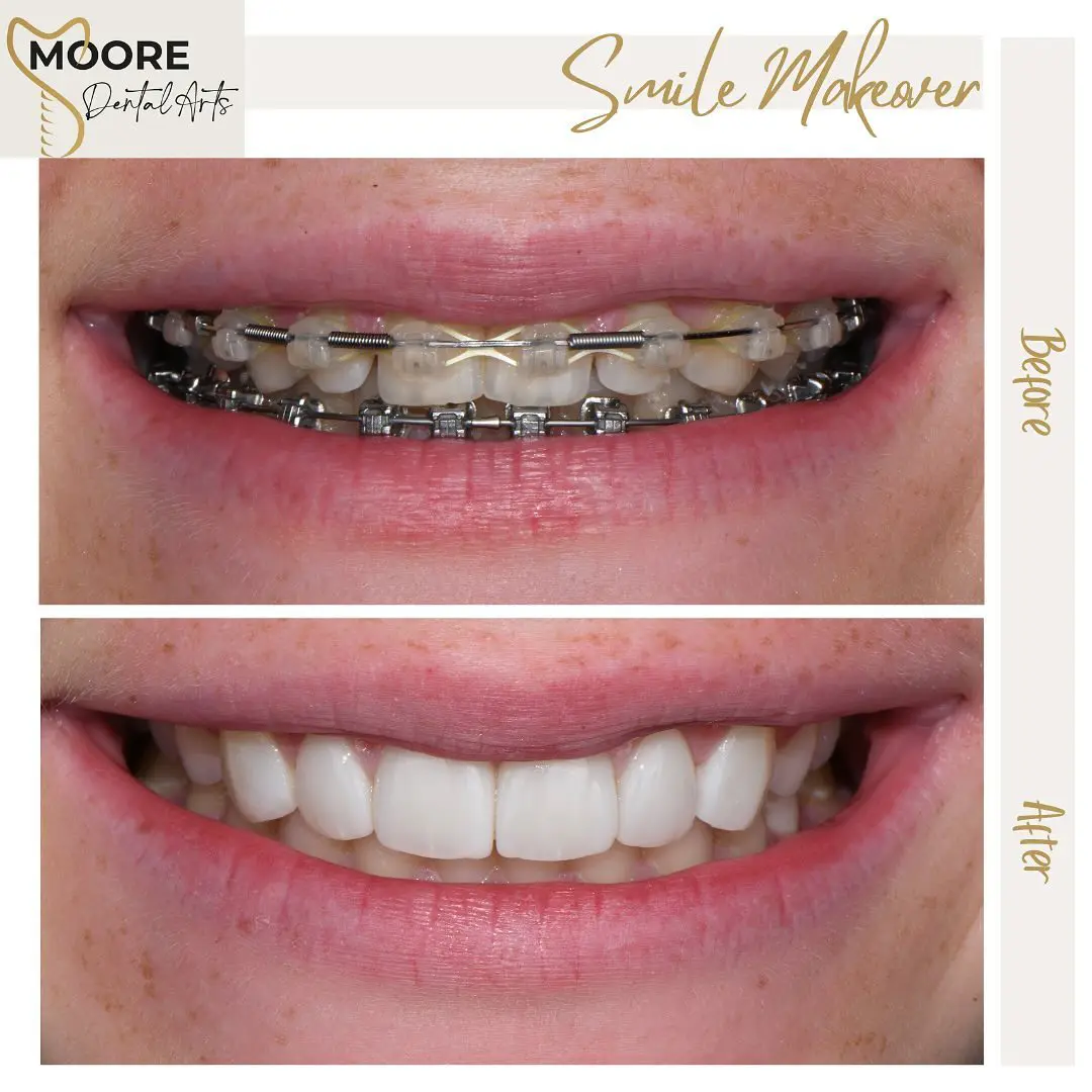 Before And After Braces Of Braces Showing A Straightened Smile