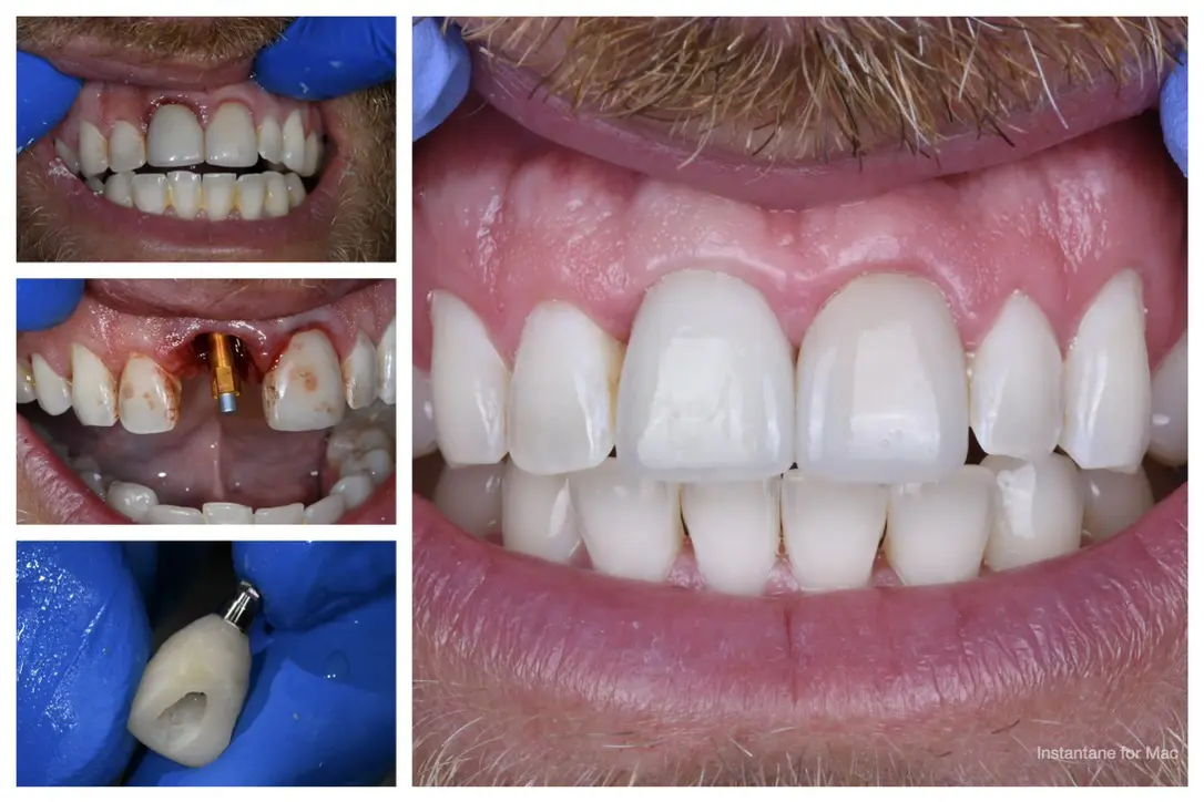 Before And After Dental Implants Collage