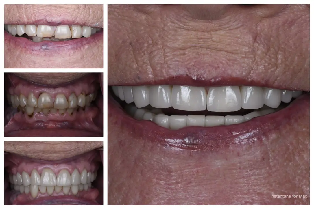 Before And After Collage Of A Smile Makeover
