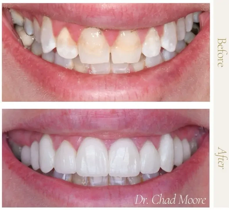 Before And After Smile Restoration And Whitening