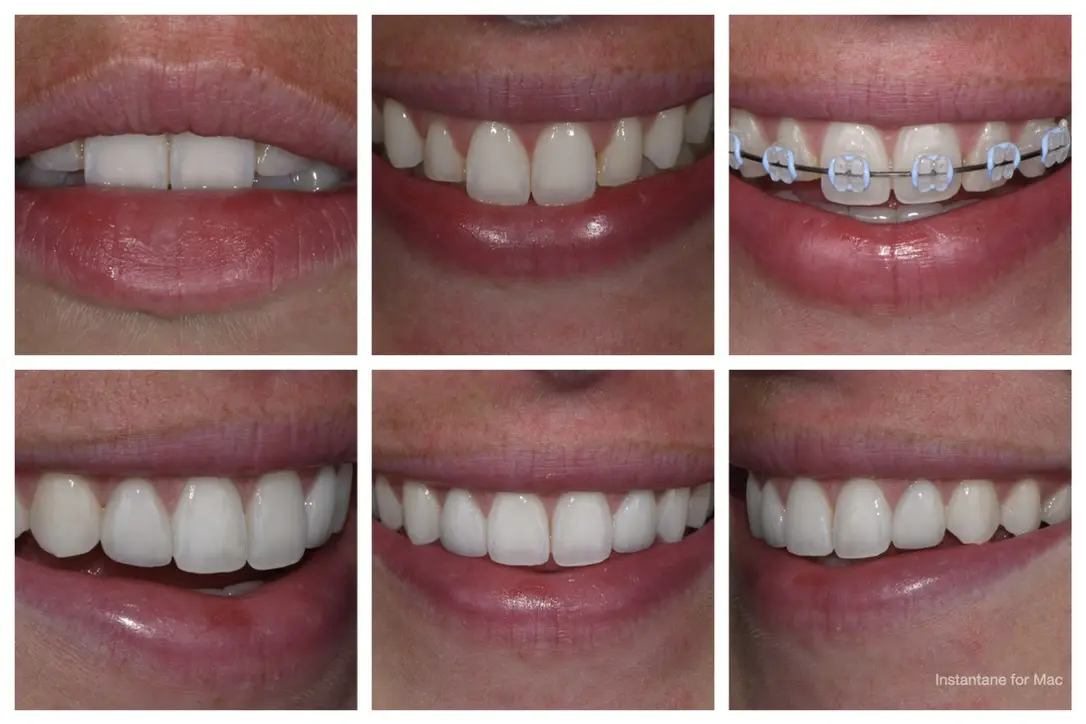 Smile Collage Showing Before And After Braces