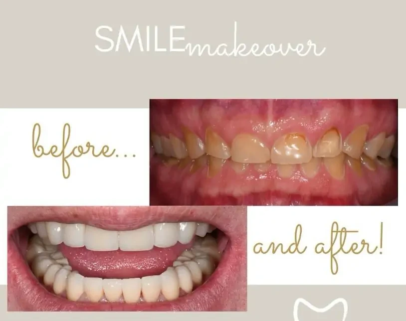 Smile Makeover Before After