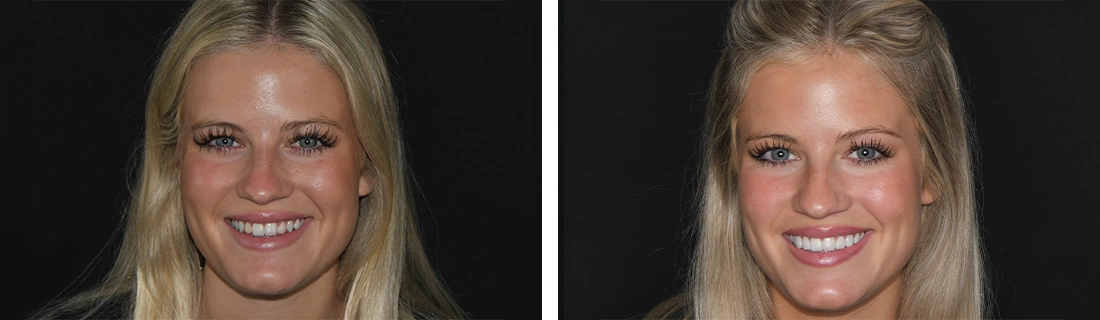 Before And After Dental Veneers