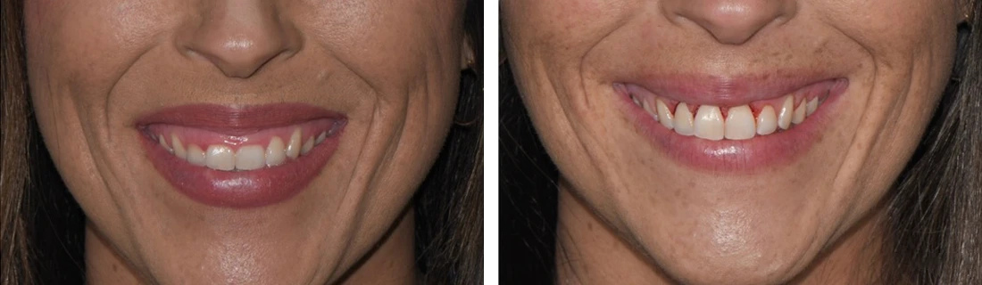 Gum Lift Before And After