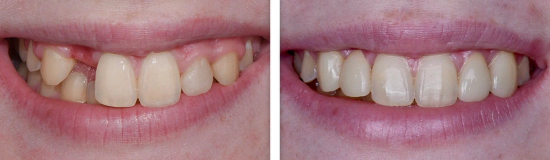 Crooked, uneven teeth improved to straighter, more uniform smile
