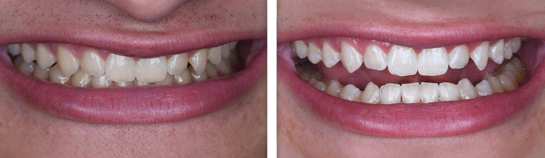 Teeth Whitening in Flowood MS